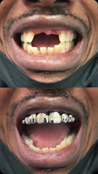 Grillz for Missing Teeth