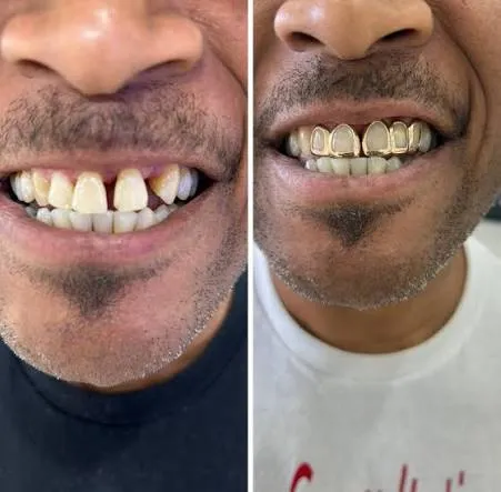 Grillz for Missing Teeth