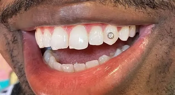 Tooth gems