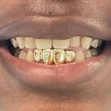 4 tooth grillz