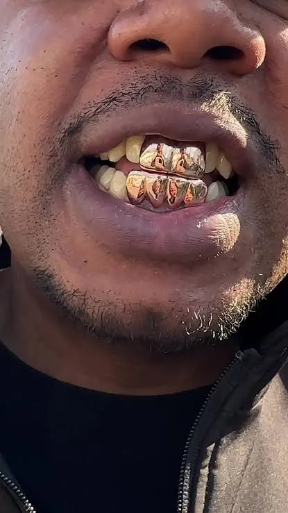 Custom rose gold grillz showing top and bottom teeth with diamond details