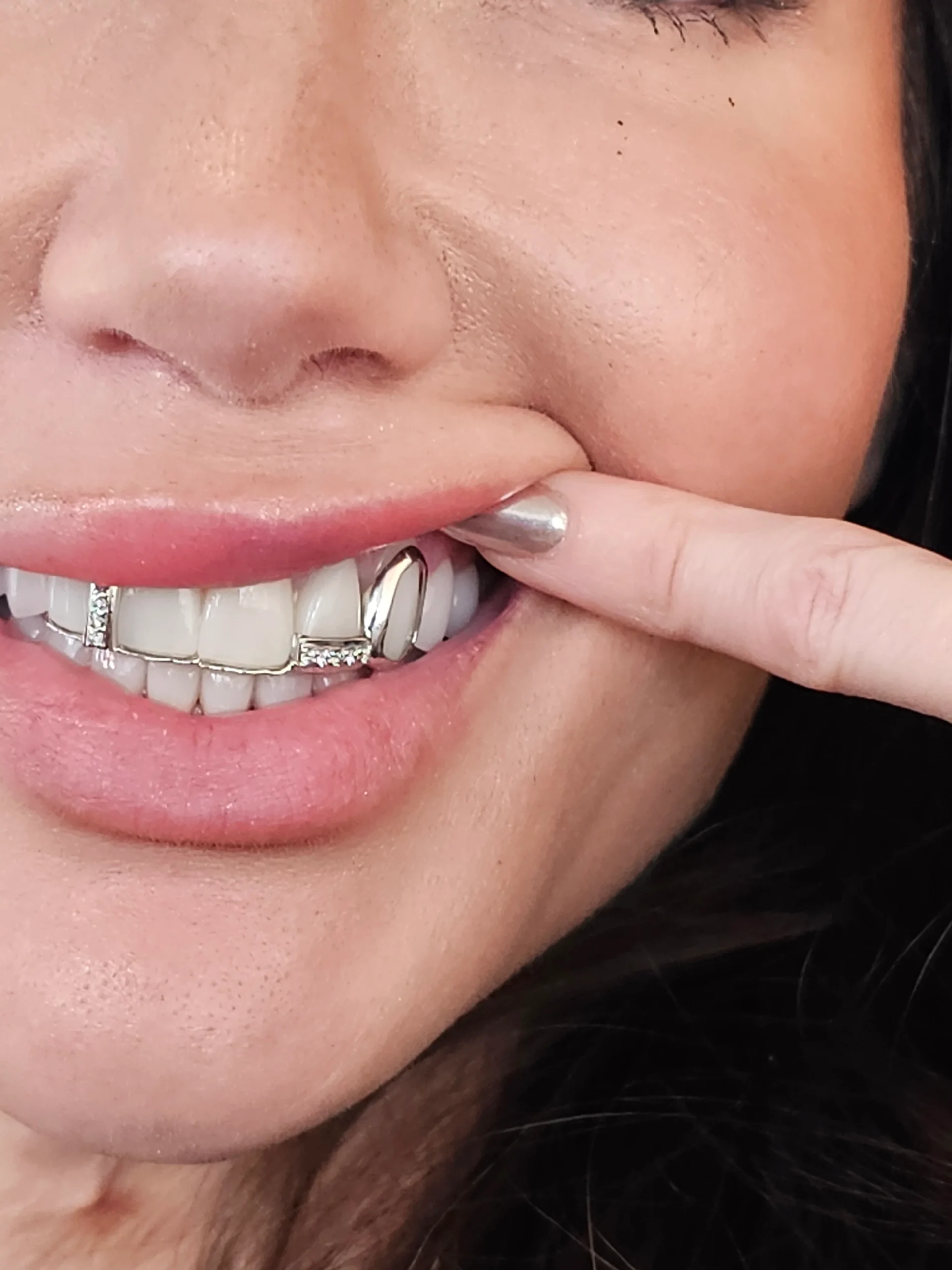 Grillz After Braces