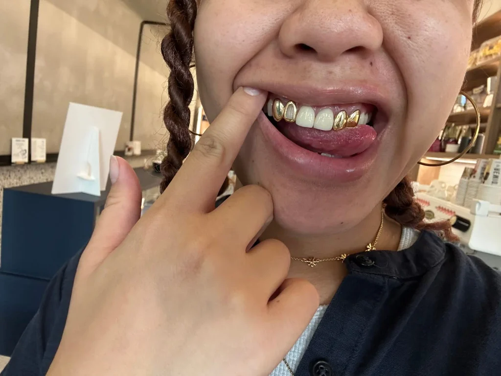 Grillz After Braces