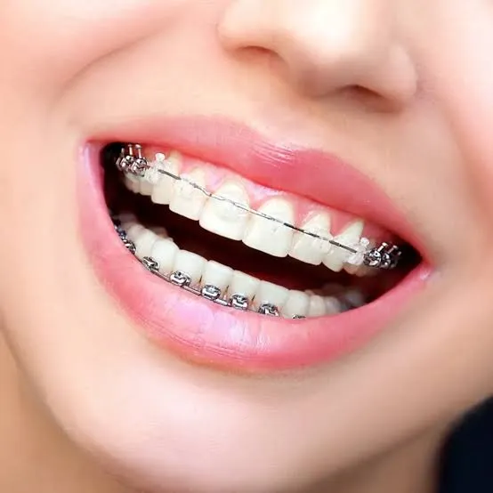 grillz with braces custom dental jewelry