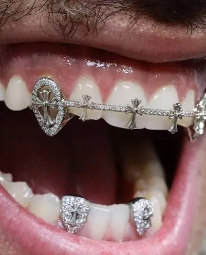 Grillz With Braces