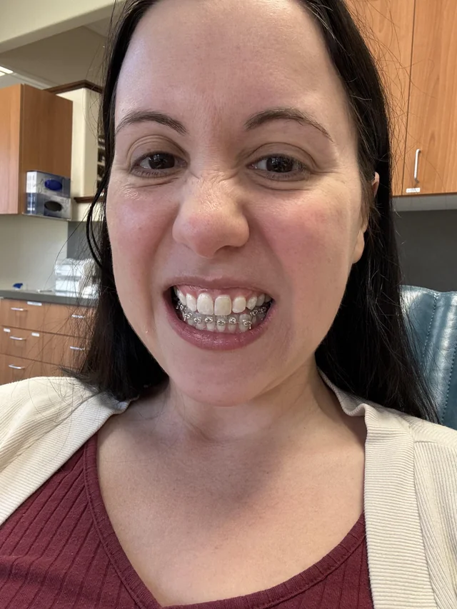 Grillz After Braces